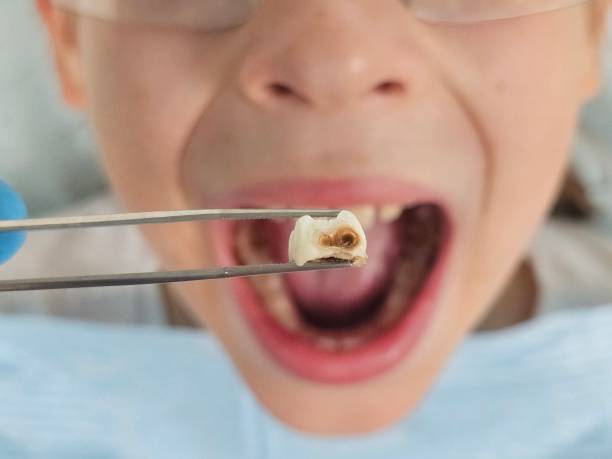 Best Tooth Infection Emergency Dentist  in Royston, GA